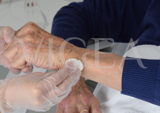 quitar manchas manos medicina estetica